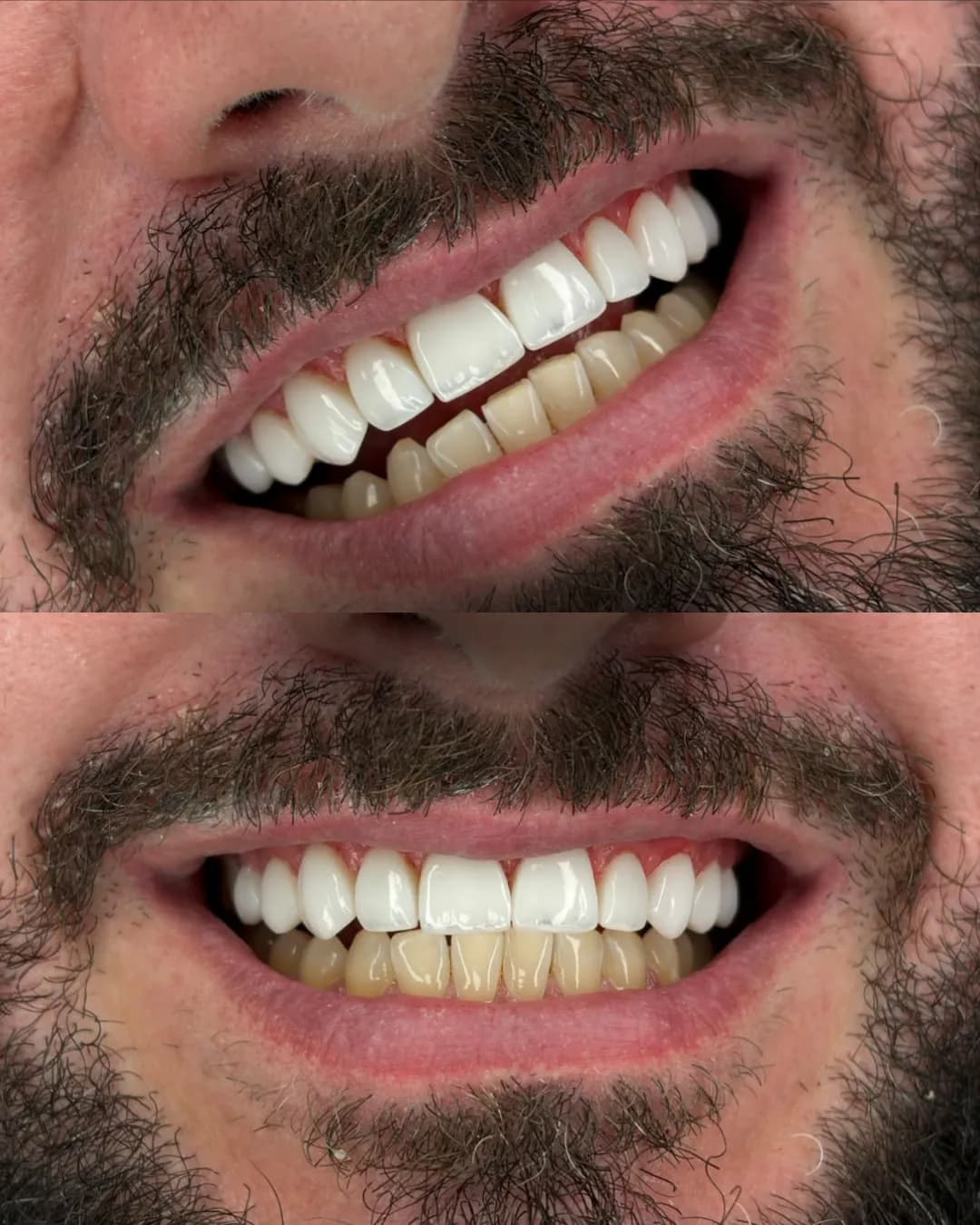 Antes e depois, Facetas em porcelana
