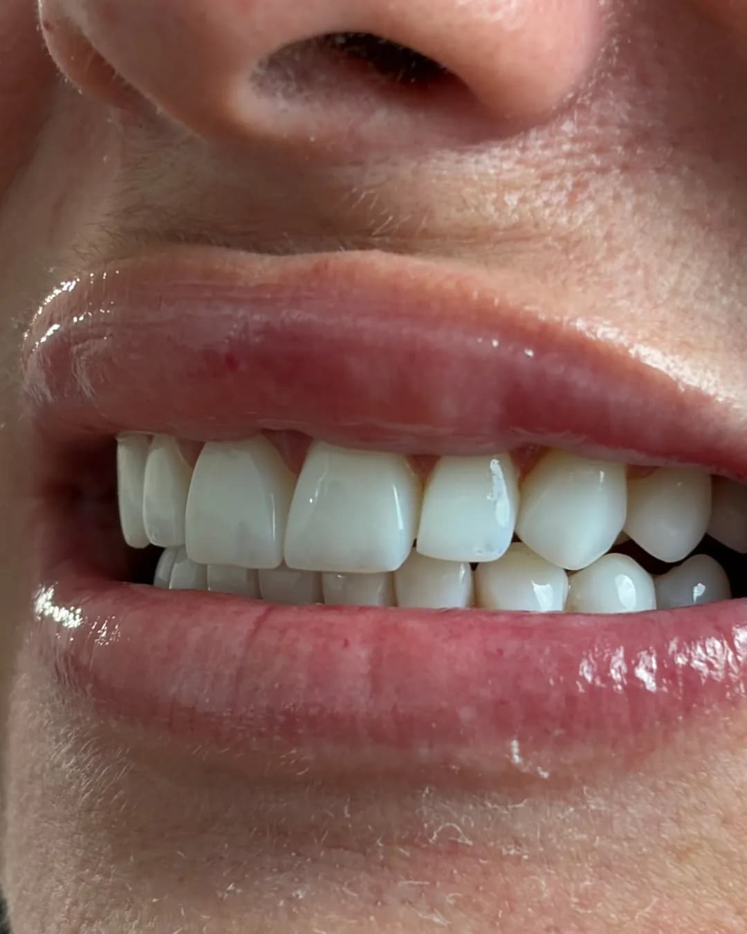 Antes e depois, Facetas em porcelana