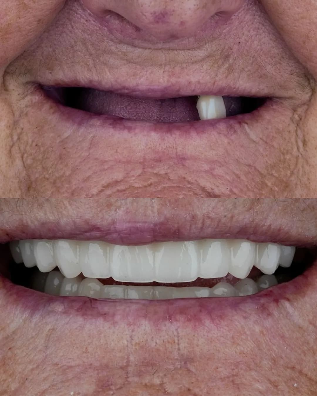 Antes e depois, Prótese protocolo