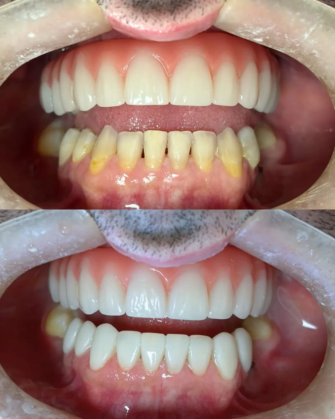 Antes e depois, Protocolo superior com facetas inferiores